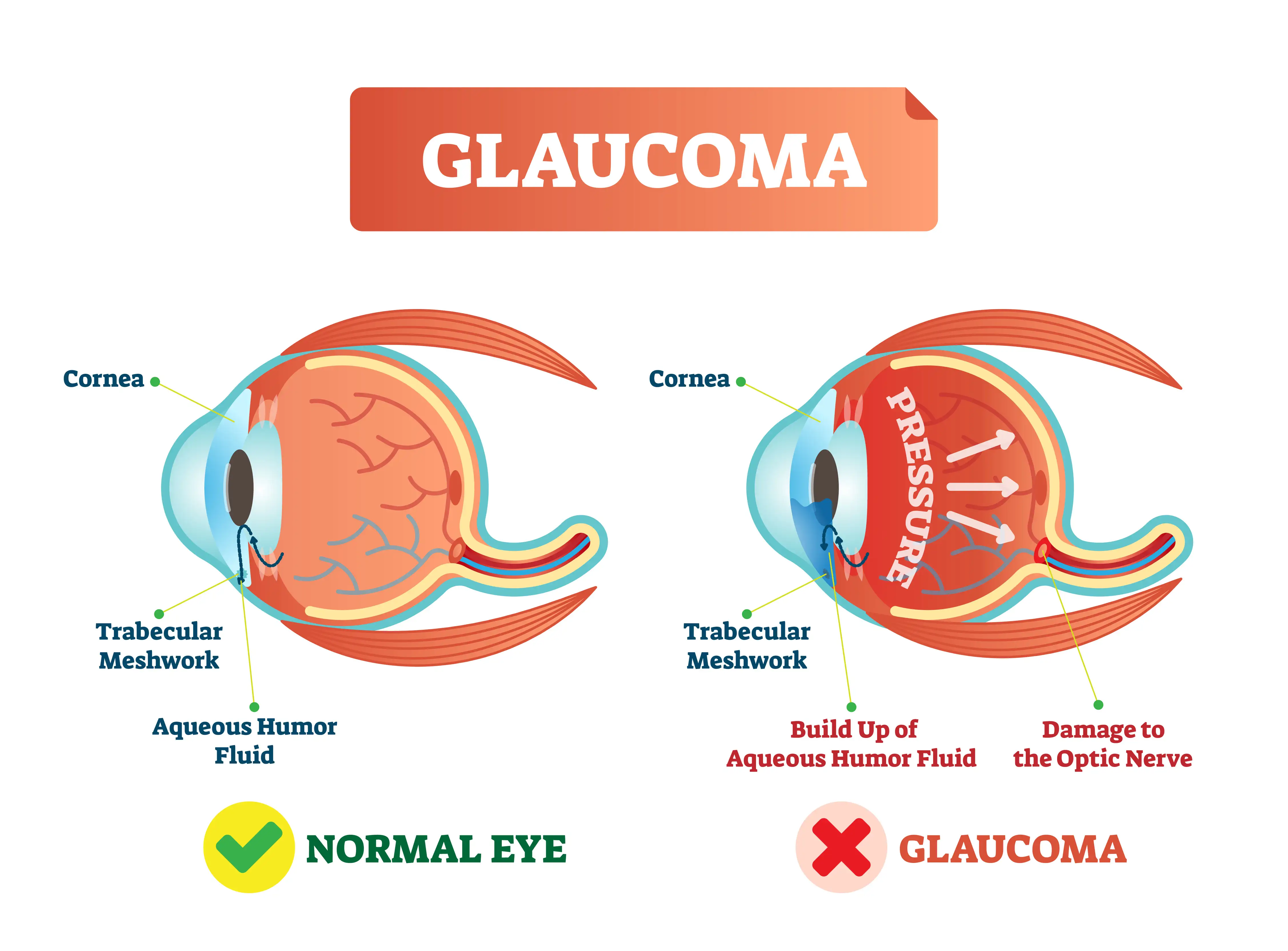 types-of-glaucoma